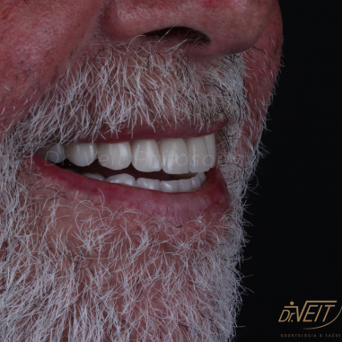 https_drveit.com.br_casos-clinicos_reabilitacao-oral-com-implantes-de-carga-imediata-5__2