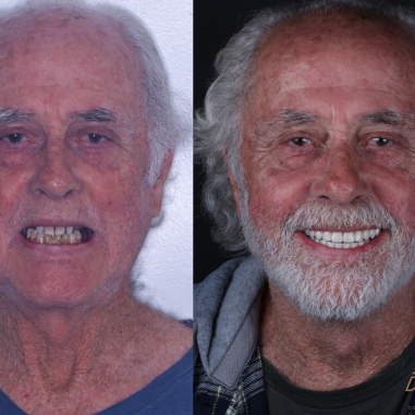 https_drveit.com.br_casos-clinicos_reabilitacao-oral-com-implantes-de-carga-imediata-5__4