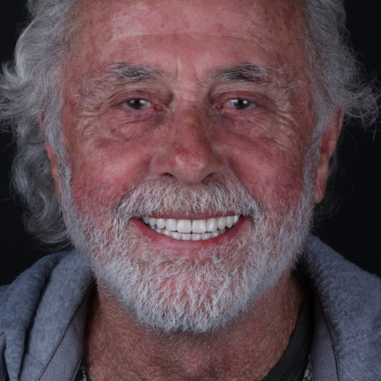 https_drveit.com.br_casos-clinicos_reabilitacao-oral-com-implantes-de-carga-imediata-5__6