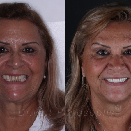 https_drveit.com.br_casos-clinicos_reabilitacao-oral-com-implantes-de-carga-imediata-7__1