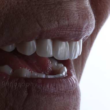 https_drveit.com.br_casos-clinicos_reabilitacao-oral-com-implantes-de-carga-imediata-7__7