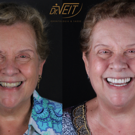 https_drveit.com.br_casos-clinicos_reabilitacao-oral-com-implantes-de-carga-imediata-8__7