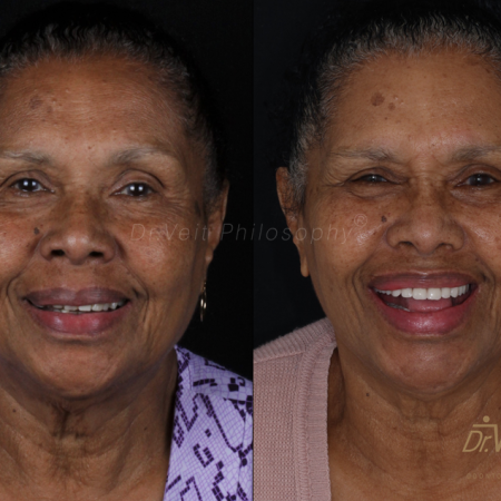 https_drveit.com.br_casos-clinicos_reabilitacao-oral-com-implantes-de-carga-imediata-9__1