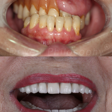 https_drveit.com.br_casos-clinicos_reabilitacao-oral-com-implantes-zigomaticos-10__2