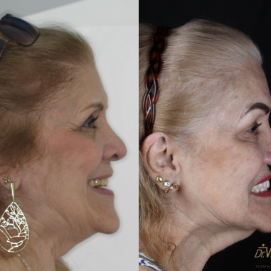 https_drveit.com.br_casos-clinicos_reabilitacao-oral-com-implantes-zigomaticos-10__3