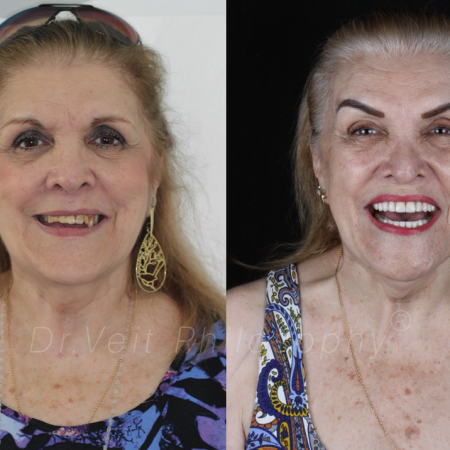 https_drveit.com.br_casos-clinicos_reabilitacao-oral-com-implantes-zigomaticos-10__4