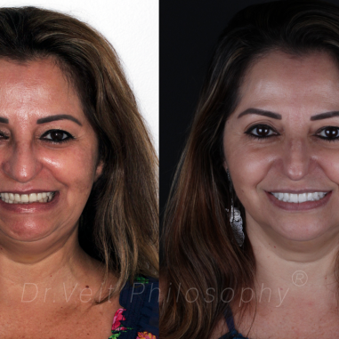 https_drveit.com.br_casos-clinicos_reabilitacao-oral-com-implantes-zigomaticos-11__1