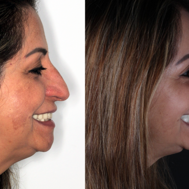 https_drveit.com.br_casos-clinicos_reabilitacao-oral-com-implantes-zigomaticos-11__5