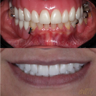 https_drveit.com.br_casos-clinicos_reabilitacao-oral-com-implantes-zigomaticos-11__7