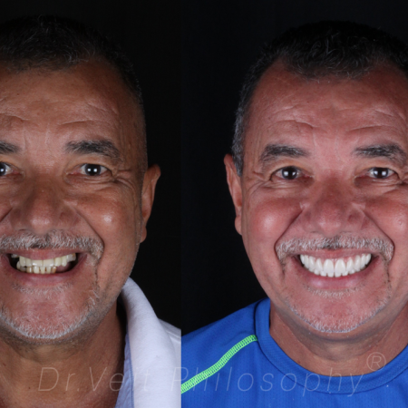 https_drveit.com.br_casos-clinicos_reabilitacao-oral-com-implantes-zigomaticos-12__1