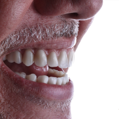 https_drveit.com.br_casos-clinicos_reabilitacao-oral-com-implantes-zigomaticos-12__3