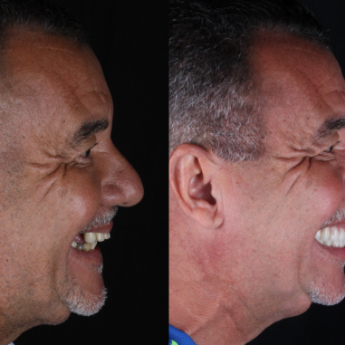 https_drveit.com.br_casos-clinicos_reabilitacao-oral-com-implantes-zigomaticos-12__5