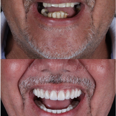 https_drveit.com.br_casos-clinicos_reabilitacao-oral-com-implantes-zigomaticos-12__7