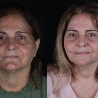 https_drveit.com.br_casos-clinicos_reabilitacao-oral-com-implantes-zigomaticos-13__9