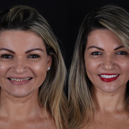 https_drveit.com.br_casos-clinicos_reabilitacao-oral-com-implantes-zigomaticos-14__1