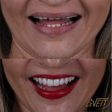 https_drveit.com.br_casos-clinicos_reabilitacao-oral-com-implantes-zigomaticos-14__3