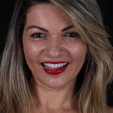 https_drveit.com.br_casos-clinicos_reabilitacao-oral-com-implantes-zigomaticos-14__4