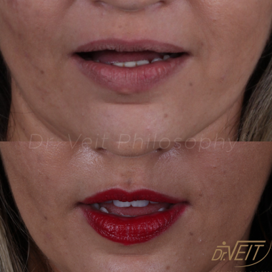 https_drveit.com.br_casos-clinicos_reabilitacao-oral-com-implantes-zigomaticos-14__5