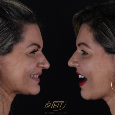 https_drveit.com.br_casos-clinicos_reabilitacao-oral-com-implantes-zigomaticos-14__6