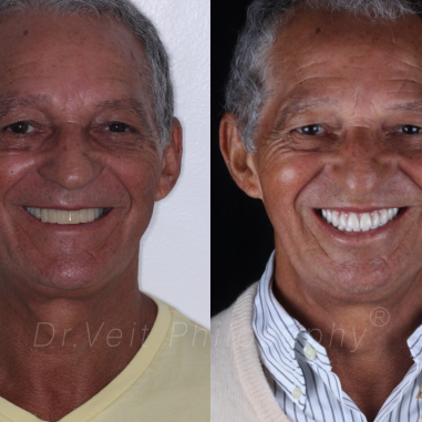 https_drveit.com.br_casos-clinicos_reabilitacao-oral-com-implantes-zigomaticos-15__1