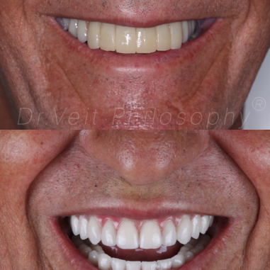 https_drveit.com.br_casos-clinicos_reabilitacao-oral-com-implantes-zigomaticos-15__2