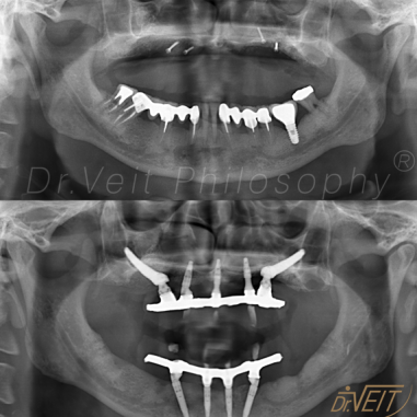 https_drveit.com.br_casos-clinicos_reabilitacao-oral-com-implantes-zigomaticos-15__5