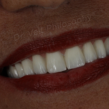 https_drveit.com.br_casos-clinicos_reabilitacao-oral-com-implantes-zigomaticos-2__4