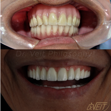 https_drveit.com.br_casos-clinicos_reabilitacao-oral-com-implantes-zigomaticos-2__6