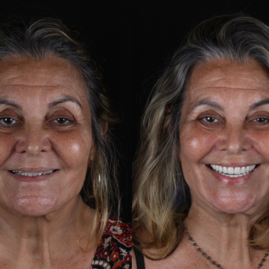 https_drveit.com.br_casos-clinicos_reabilitacao-oral-com-implantes-zigomaticos-3__1