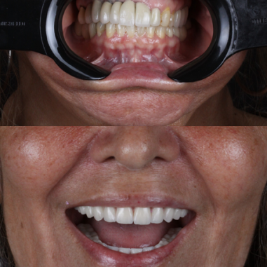 https_drveit.com.br_casos-clinicos_reabilitacao-oral-com-implantes-zigomaticos-3__6