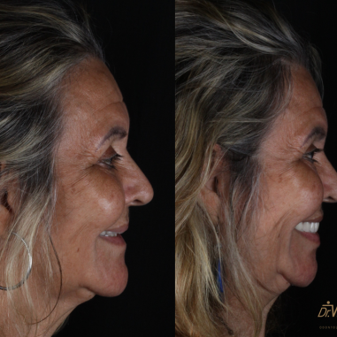 https_drveit.com.br_casos-clinicos_reabilitacao-oral-com-implantes-zigomaticos-3__7