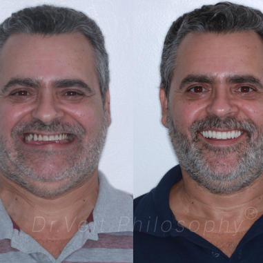 https_drveit.com.br_casos-clinicos_reabilitacao-oral-com-implantes-zigomaticos-4__1