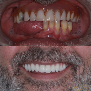 https_drveit.com.br_casos-clinicos_reabilitacao-oral-com-implantes-zigomaticos-4__4