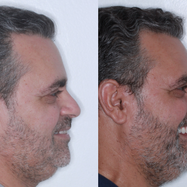 https_drveit.com.br_casos-clinicos_reabilitacao-oral-com-implantes-zigomaticos-4__5