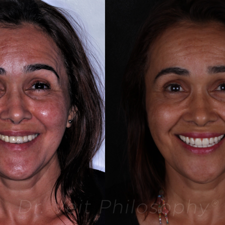 https_drveit.com.br_casos-clinicos_reabilitacao-oral-com-implantes-zigomaticos-5__1