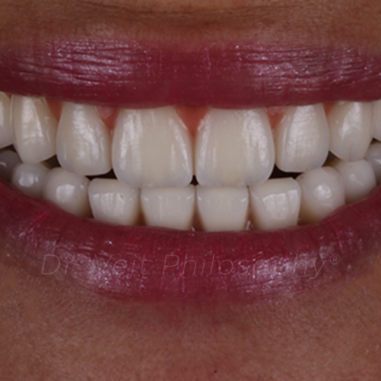 https_drveit.com.br_casos-clinicos_reabilitacao-oral-com-implantes-zigomaticos-5__5