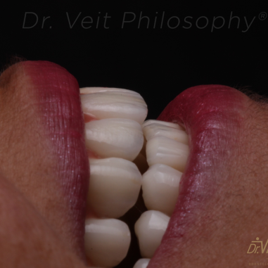 https_drveit.com.br_casos-clinicos_reabilitacao-oral-com-implantes-zigomaticos-5__7