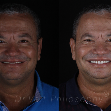 https_drveit.com.br_casos-clinicos_reabilitacao-oral-com-implantes-zigomaticos-6__1