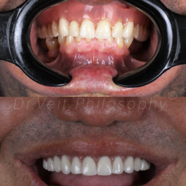 https_drveit.com.br_casos-clinicos_reabilitacao-oral-com-implantes-zigomaticos-6__7