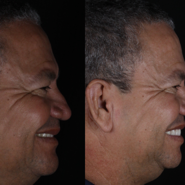 https_drveit.com.br_casos-clinicos_reabilitacao-oral-com-implantes-zigomaticos-6__8