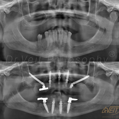 https_drveit.com.br_casos-clinicos_reabilitacao-oral-com-implantes-zigomaticos-6__9