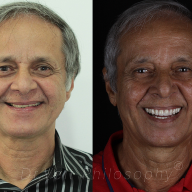 https_drveit.com.br_casos-clinicos_reabilitacao-oral-com-implantes-zigomaticos-7__1