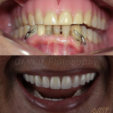 https_drveit.com.br_casos-clinicos_reabilitacao-oral-com-implantes-zigomaticos-7__2