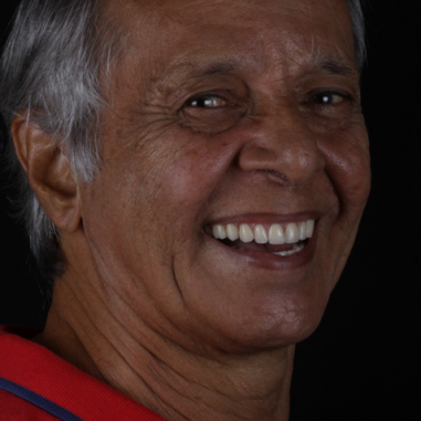 https_drveit.com.br_casos-clinicos_reabilitacao-oral-com-implantes-zigomaticos-7__6