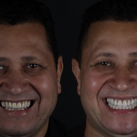 https_drveit.com.br_casos-clinicos_reabilitacao-oral-com-implantes-zigomaticos-8__1