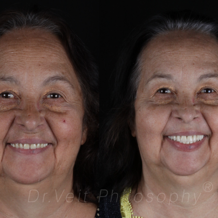 https_drveit.com.br_casos-clinicos_reabilitacao-oral-com-implantes-zigomaticos-9__1