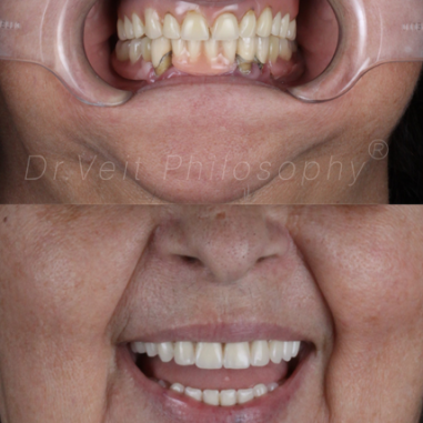 https_drveit.com.br_casos-clinicos_reabilitacao-oral-com-implantes-zigomaticos-9__4