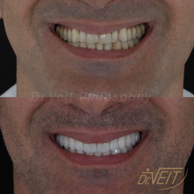 https_drveit.com.br_casos-clinicos_reabilitacao-oral-com-lentes-de-contato-3__6