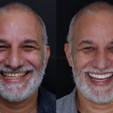 https_drveit.com.br_casos-clinicos_reabilitacao-oral-com-lentes-de-contato-4__1