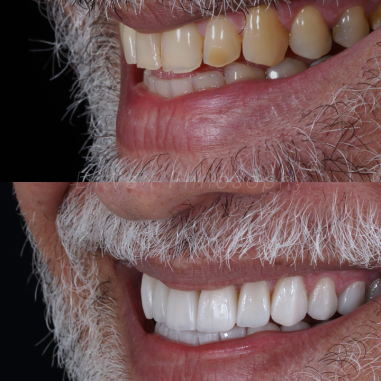 https_drveit.com.br_casos-clinicos_reabilitacao-oral-com-lentes-de-contato-4__2